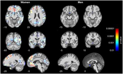 Low bone mineral density is associated with gray matter volume decrease in UK Biobank